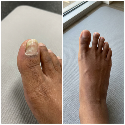 EPIDEX Fungal Nail Renewal Patches