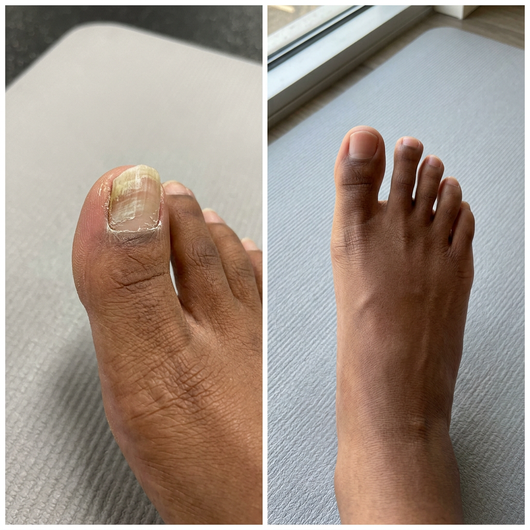 EPIDEX Fungal Nail Renewal Patches