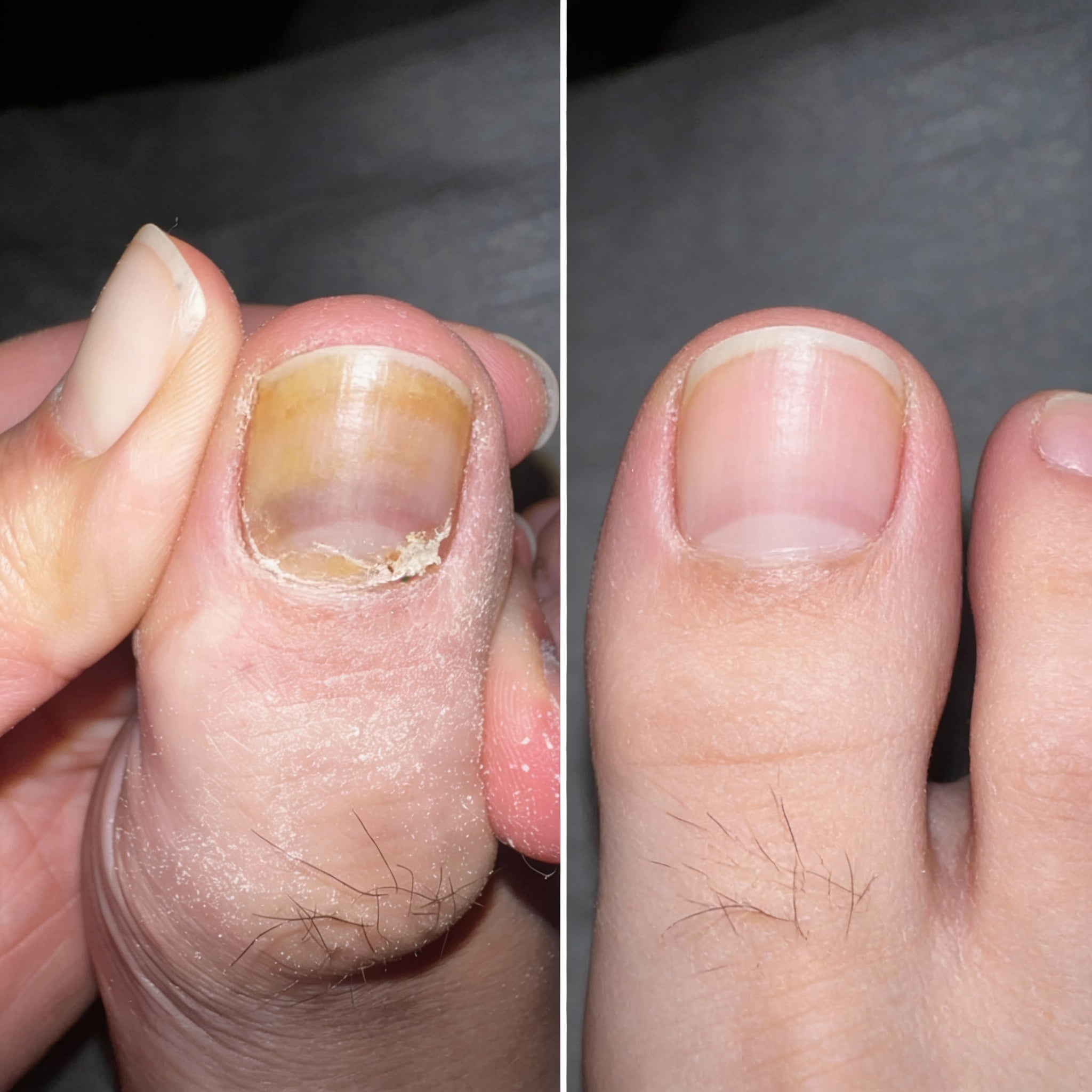 EPIDEX Fungal Nail Renewal Patches (6 Weeks)