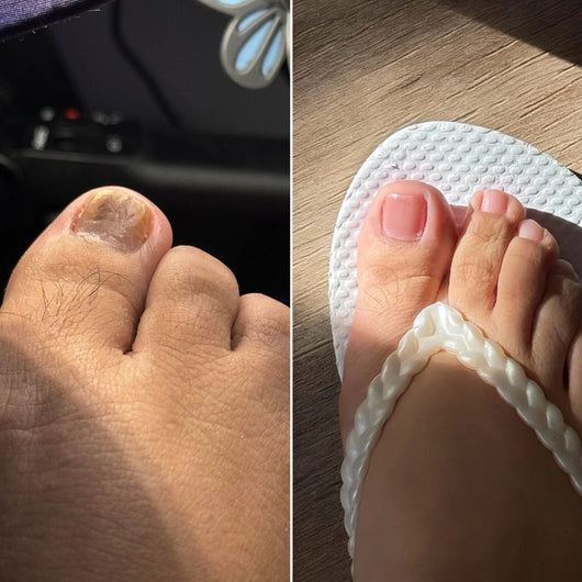 EPIDEX Fungal Nail Renewal Patches